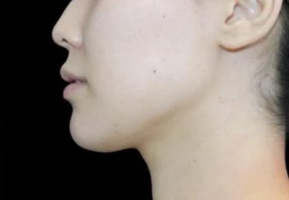 Neck Liposuction Before & After Patient #617