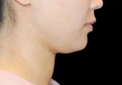Neck Liposuction Before & After Patient #617