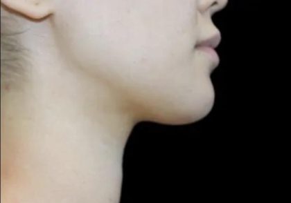 Neck Liposuction Before & After Patient #617