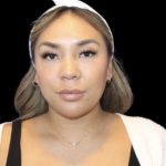 Neck Liposuction Before & After Patient #618