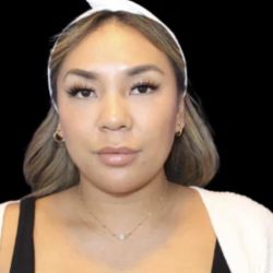 Neck Liposuction Before & After Patient #618