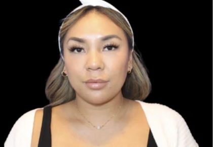 Neck Liposuction Before & After Patient #618