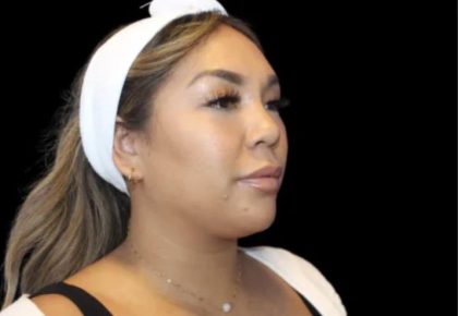 Neck Liposuction Before & After Patient #618