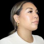 Neck Liposuction Before & After Patient #618