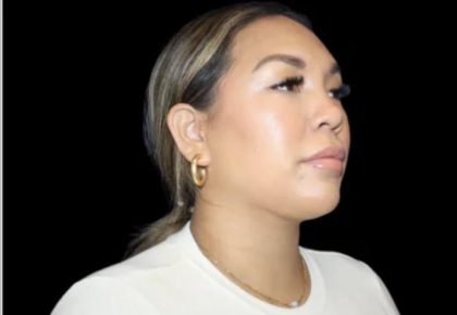 Neck Liposuction Before & After Patient #618
