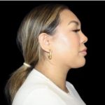 Neck Liposuction Before & After Patient #618