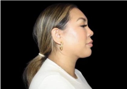 Neck Liposuction Before & After Patient #618