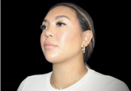 Neck Liposuction Before & After Patient #618