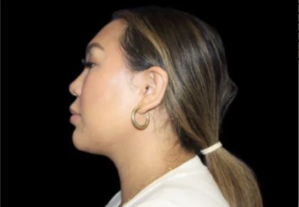 Neck Liposuction Before & After Patient #618