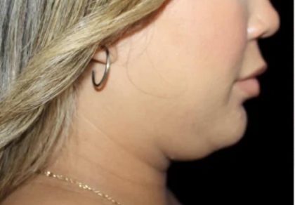Neck Liposuction Before & After Patient #618