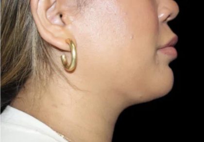 Neck Liposuction Before & After Patient #618