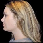 Neck Liposuction Before & After Patient #604