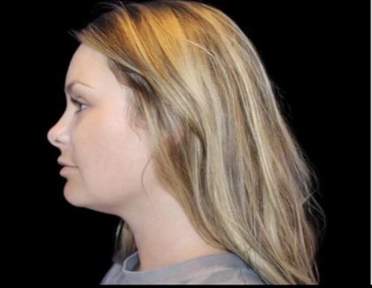 Neck Liposuction Before & After Patient #604