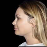 Neck Liposuction Before & After Patient #604