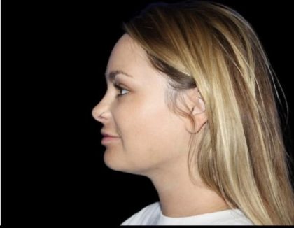 Neck Liposuction Before & After Patient #604
