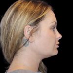 Neck Liposuction Before & After Patient #604
