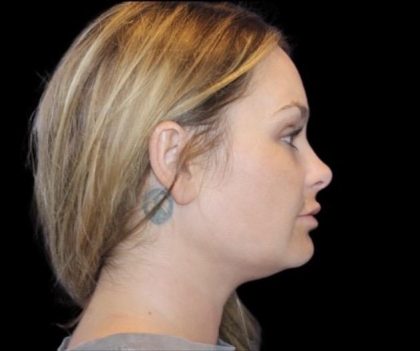 Neck Liposuction Before & After Patient #604