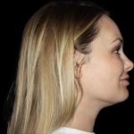 Neck Liposuction Before & After Patient #604