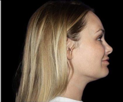 Neck Liposuction Before & After Patient #604