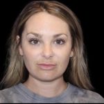 Neck Liposuction Before & After Patient #604