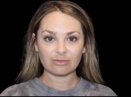 Neck Liposuction Before & After Patient #604