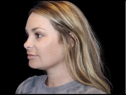 Neck Liposuction Before & After Patient #604