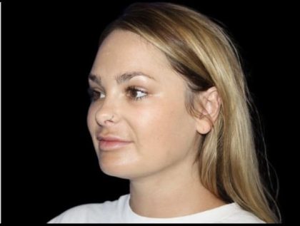 Neck Liposuction Before & After Patient #604