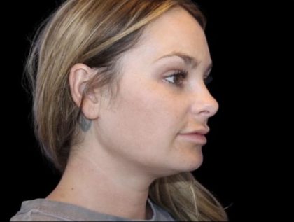 Neck Liposuction Before & After Patient #604