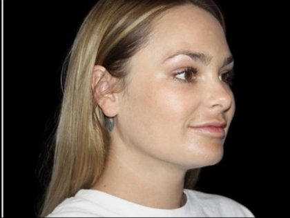 Neck Liposuction Before & After Patient #604