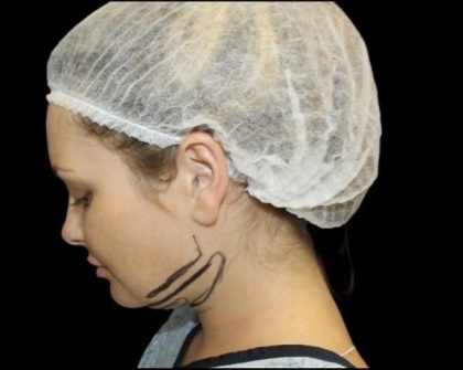Neck Liposuction Before & After Patient #604