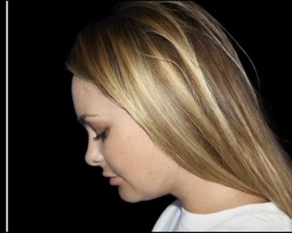 Neck Liposuction Before & After Patient #604