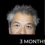 Microneedling with PRP Before & After Patient #648