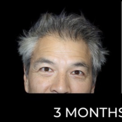 Microneedling with PRP Before & After Patient #648
