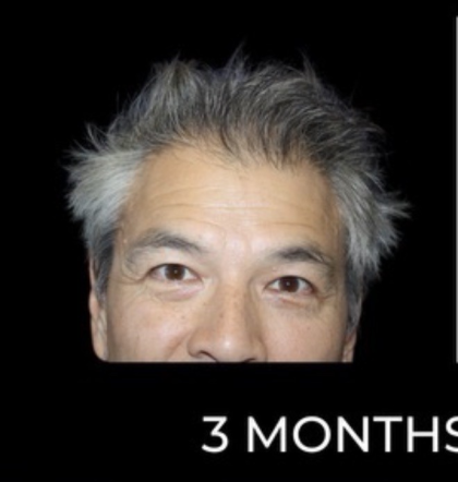 Microneedling with PRP Before & After Patient #648