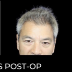 Microneedling with PRP Before & After Patient #648