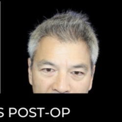 Microneedling with PRP Before & After Patient #648