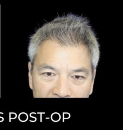 Microneedling with PRP Before & After Patient #648