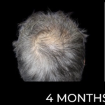 Microneedling with PRP Before & After Patient #648