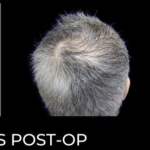 Microneedling with PRP Before & After Patient #648