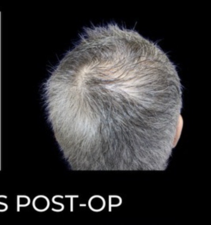 Microneedling with PRP Before & After Patient #648