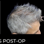 Microneedling with PRP Before & After Patient #648