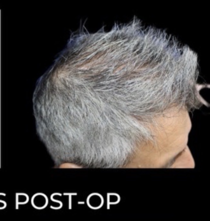 Microneedling with PRP Before & After Patient #648