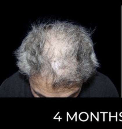 Microneedling with PRP Before & After Patient #648