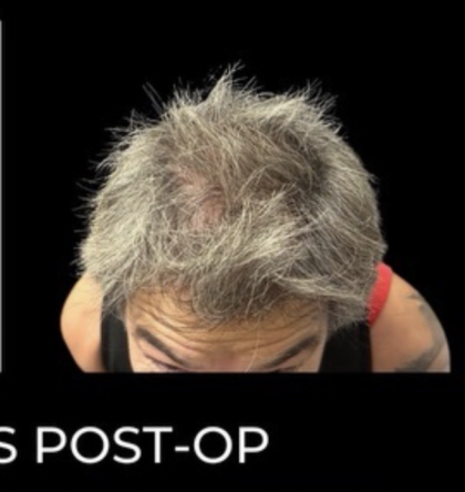 Microneedling with PRP Before & After Patient #648